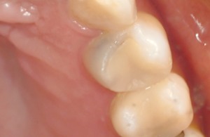 岡山と倉敷の審美歯科のセレック症例