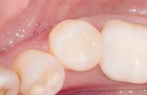 岡山と倉敷の審美歯科のセレック症例