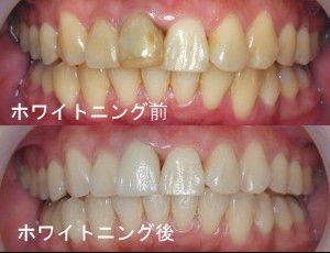 岡山と倉敷の審美歯科のオフィスホワイトニング
